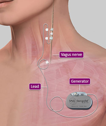 Seizure Success and You! - Vagus Nerve Stimulation (VNS)